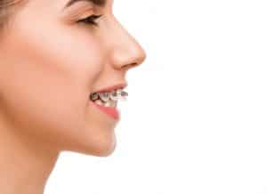 Femeie cu aparat dentar, zambind