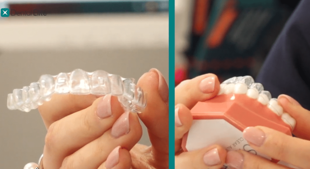 Aparat dentar Spark, transparent, in mana medicului dentist si asezat pe un mulaj dentar