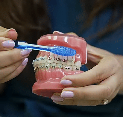 Medic care arata cum se face periajul dentar in cazul aparatului dentar cu bracketi
