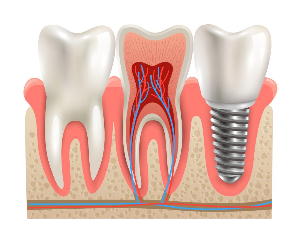 implant dentar 