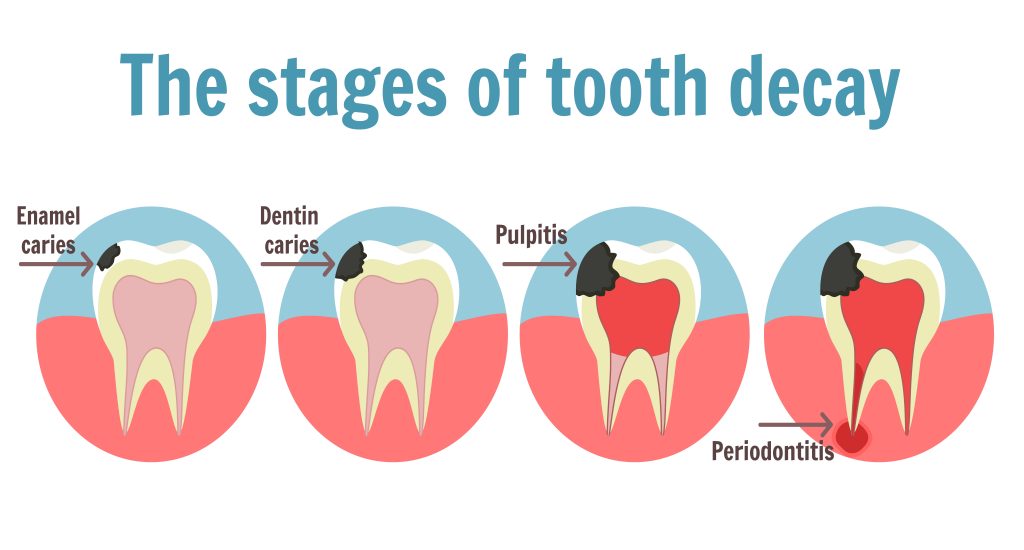 cauze pierdere dinti