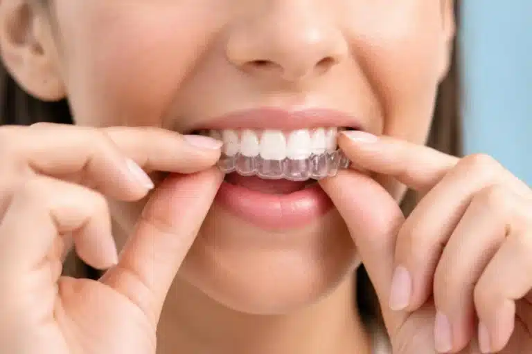 Femeie care scoate gutiera de bruxism