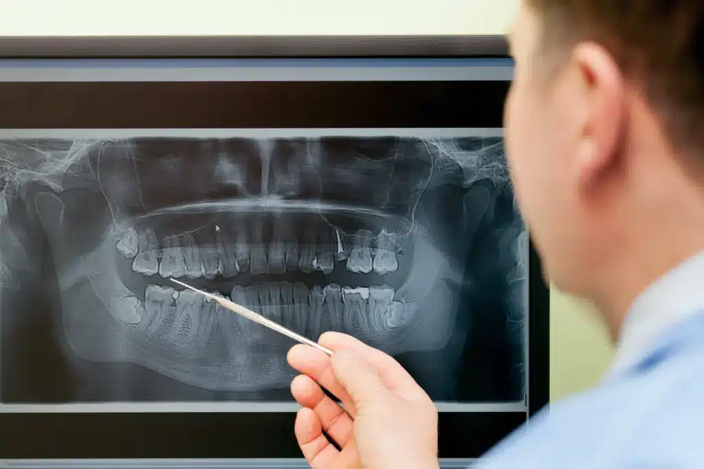 Un dentiste examine une radiographie dentaire panoramique, en indiquant la zone où un implant dentaire va être posé
