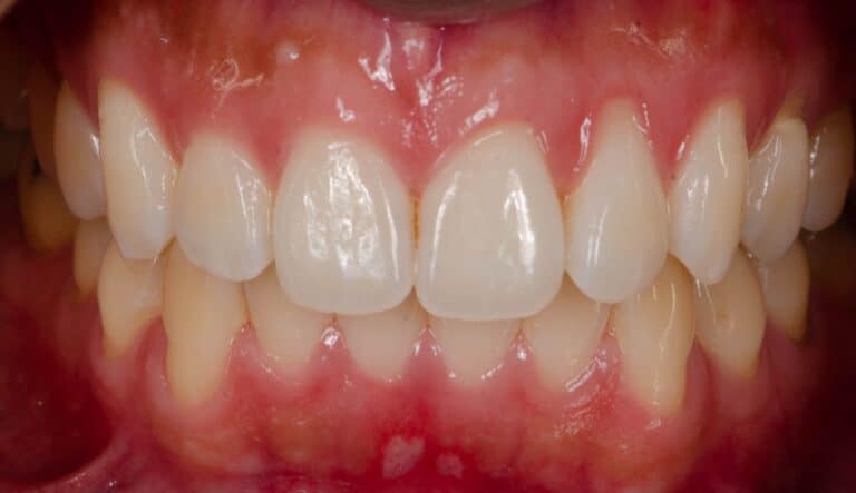 retractie gingivala
