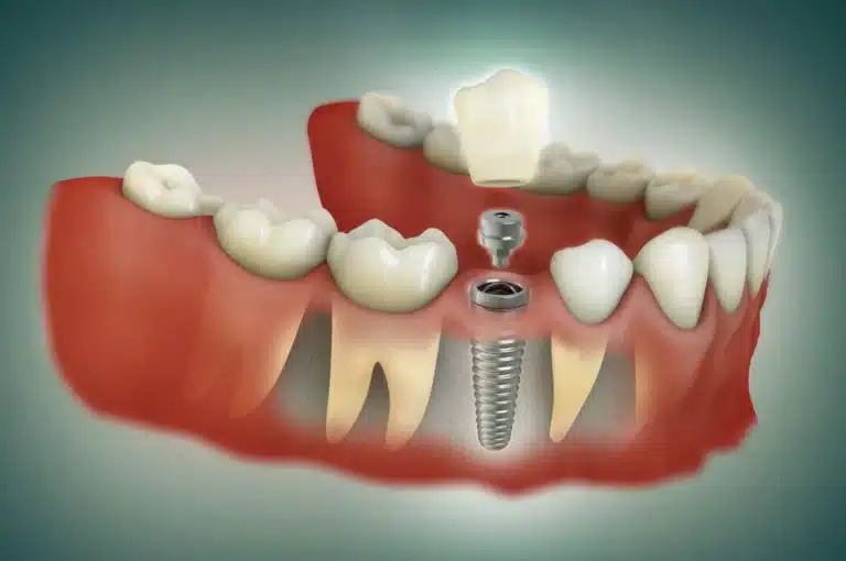 Reprezentare grafică a cavitatii bucale in care a fost inserat un implant dentar, peste care se asaza componentele (bontul protetic si coroana dentara)