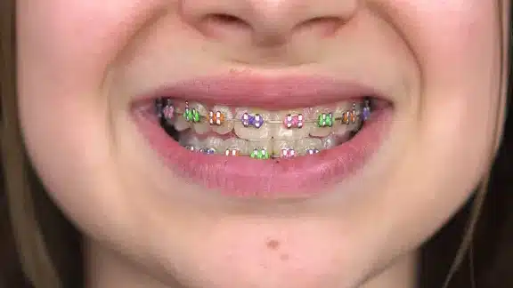Copil cu aparat dentar cu brackeți colorați