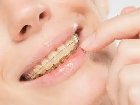 Aparat dentar ceramic safir pe dintii unei femei