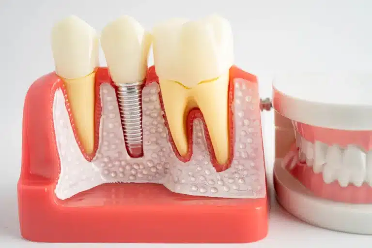 Implant dentar
