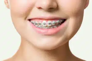 Tânără cu bracket aparat dentar metalic pe dinți, zâmbind