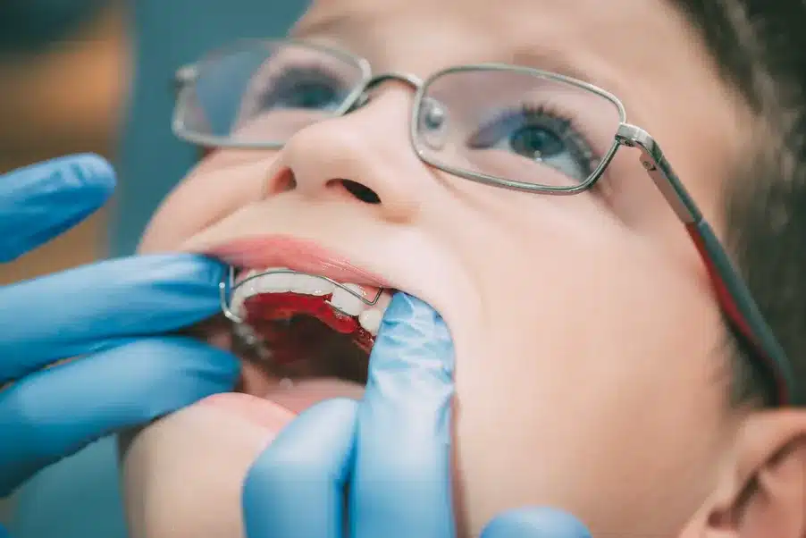Aparat dentar mobil copii