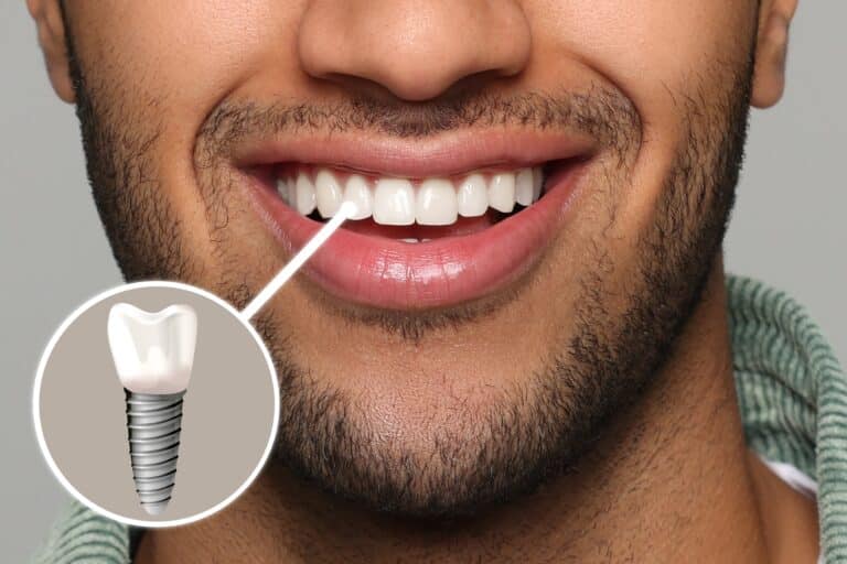implant dentar imediat vs clasic