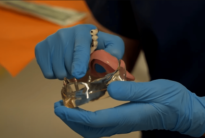 Medicul stomatolog arată pe un mulaj cum se montează implanturile dentare și lucrarea fixă