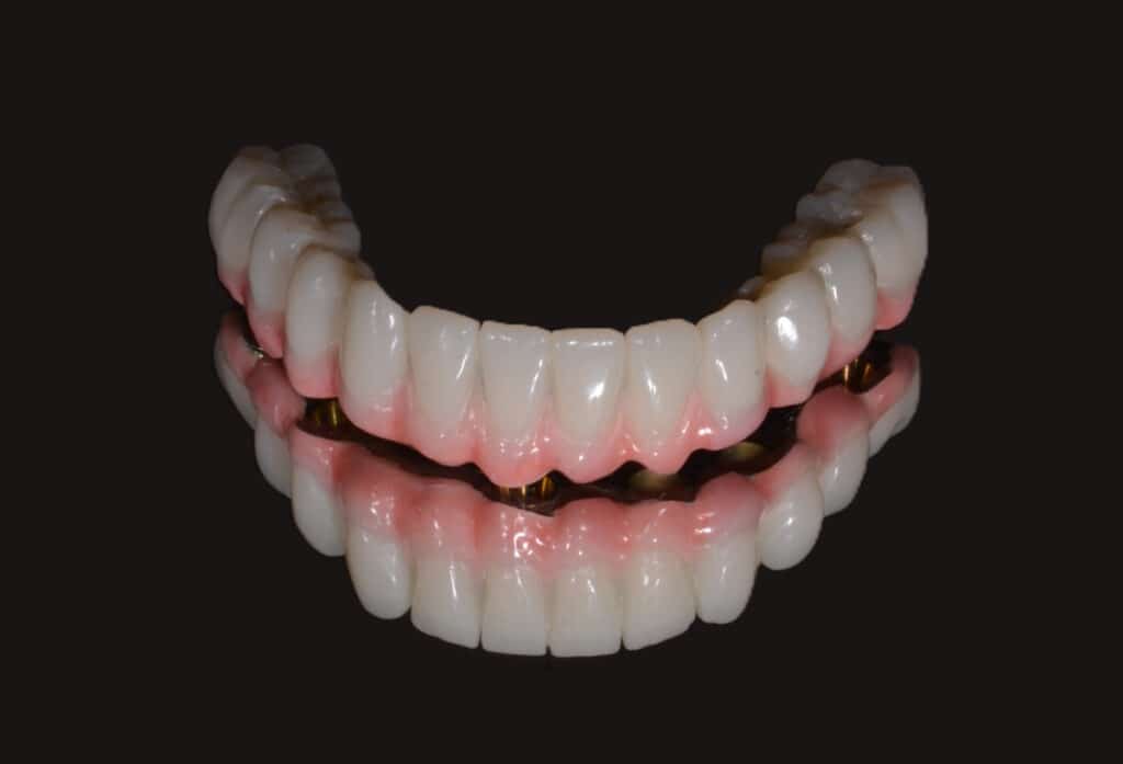 Dental work for the mandible, made of dental crowns
