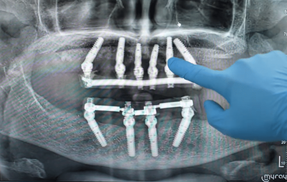 Radiografie implanturi dentare dinti ficsi in 24 de ore