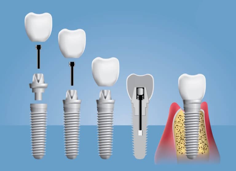 Ilustratie care arata structura implantului dentar si etapele montarii coroanei pe implant