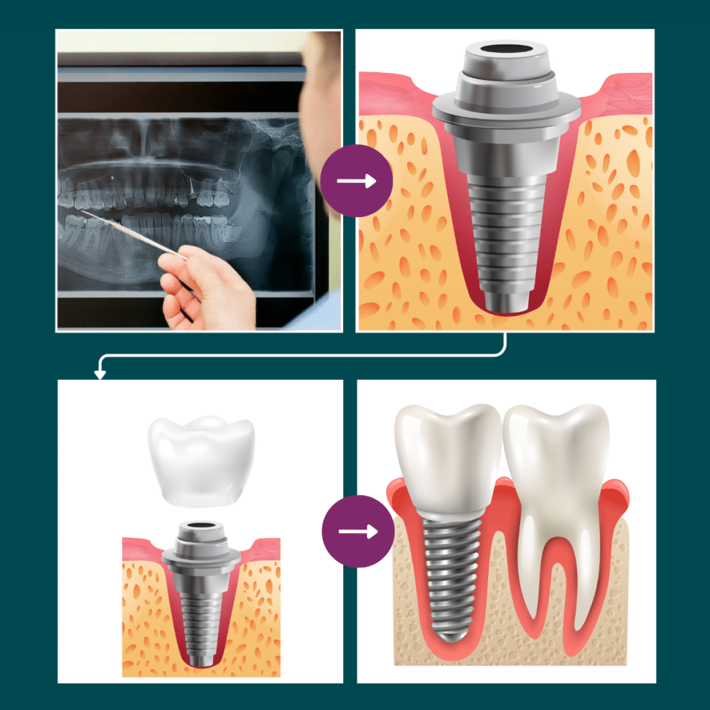 Les étapes du traitement par implants dentaires : de la radiographie panoramique à la couronne dentaire en porcelaine sur implant