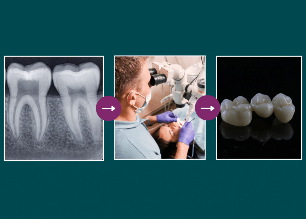 Les étapes du traitement des dents très cariées : de la radiographie aux couronnes en porcelaine