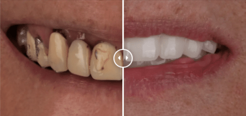 Pacienta Dental Elite, inainte si dupa intervenita Dinti ficsi cu implanturi fast&fixed