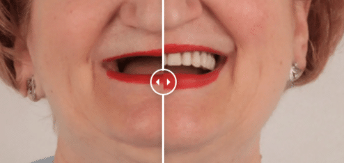 Pacienta de 60 de ani, inainte si dupa reabilitatea orala cu implanturi dentare Straumann