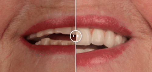 Pacienta Dental Elite de 62 de ani, cu dantura refacuta, cu Dinti Ficsi in 25 de ore