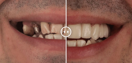 Patient before and after dental rehabilitation with ceramic and zirconium crowns