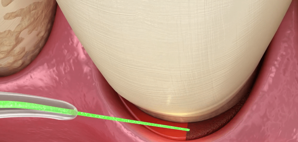 Simulare decontaminare laser gingie cu parodontoza avansata