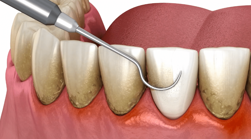 Simulare a detatrajului dentar profesional