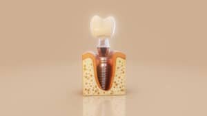 Ilustratie cu implant dentar de calitate, in gingie