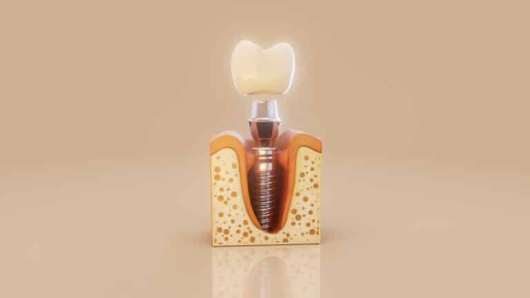 Ilustratie cu implant dentar de calitate, in gingie
