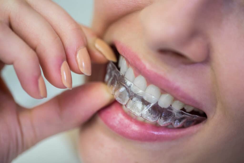Femeie care isi scoate aparatul dentar invizibil