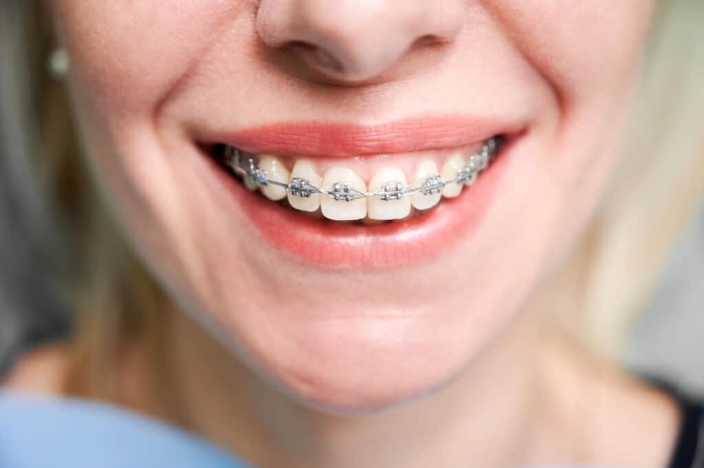 Femeie, care zambeste cu aparat dentar metalic