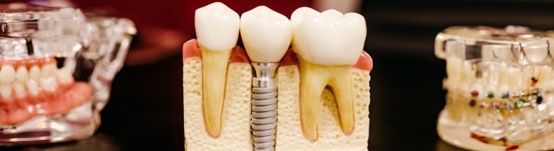 implanturi dentare vs proteza dentara